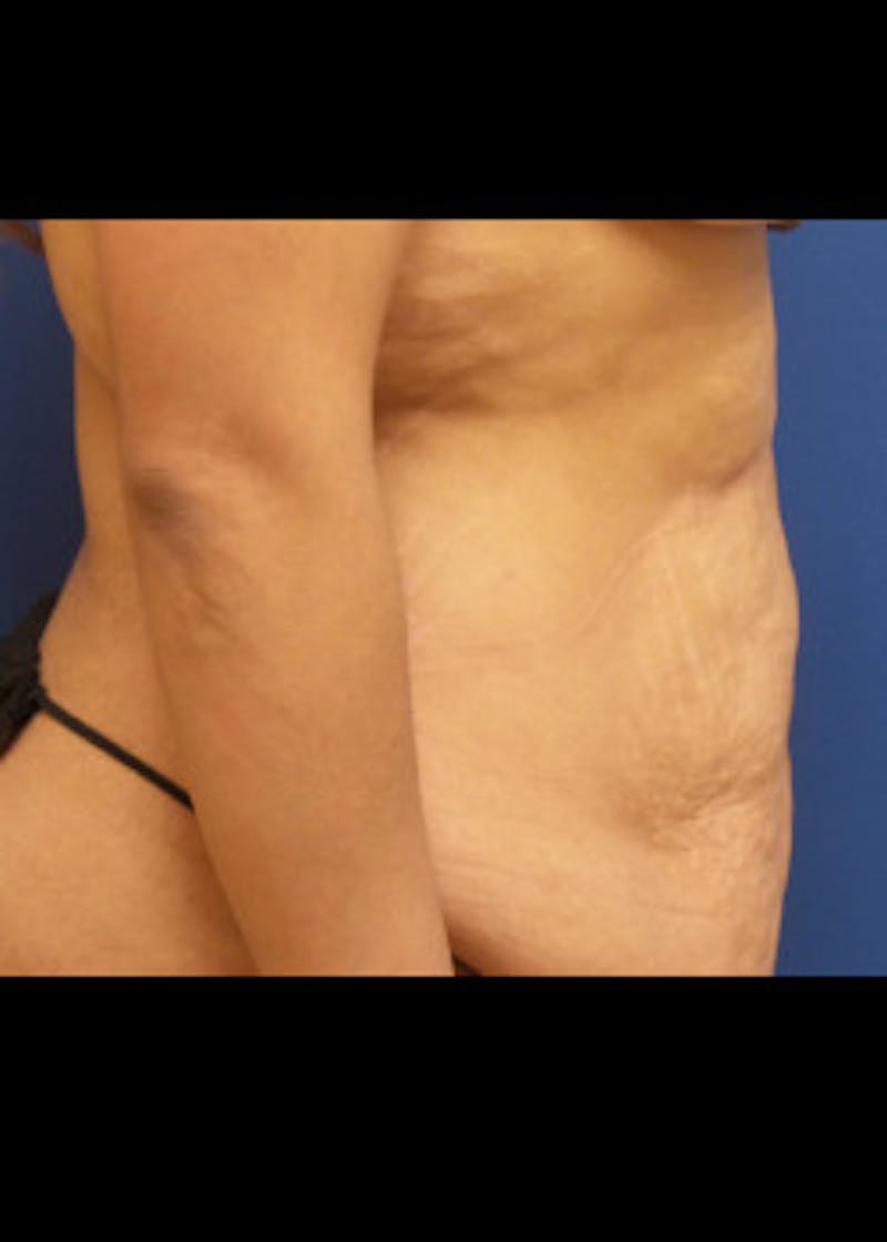Tummy Tuck Before & After Gallery - Patient 46612396 - Image 3