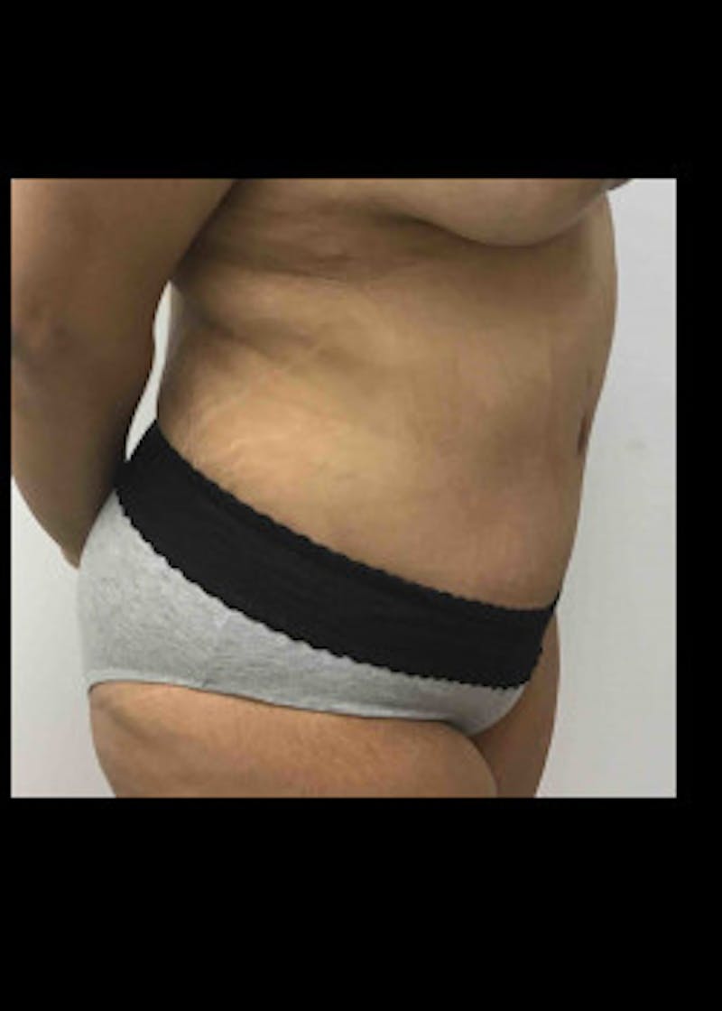 Tummy Tuck Before & After Gallery - Patient 46612396 - Image 4