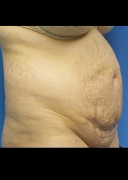 Tummy Tuck Gallery - Patient 46612424 - Image 3