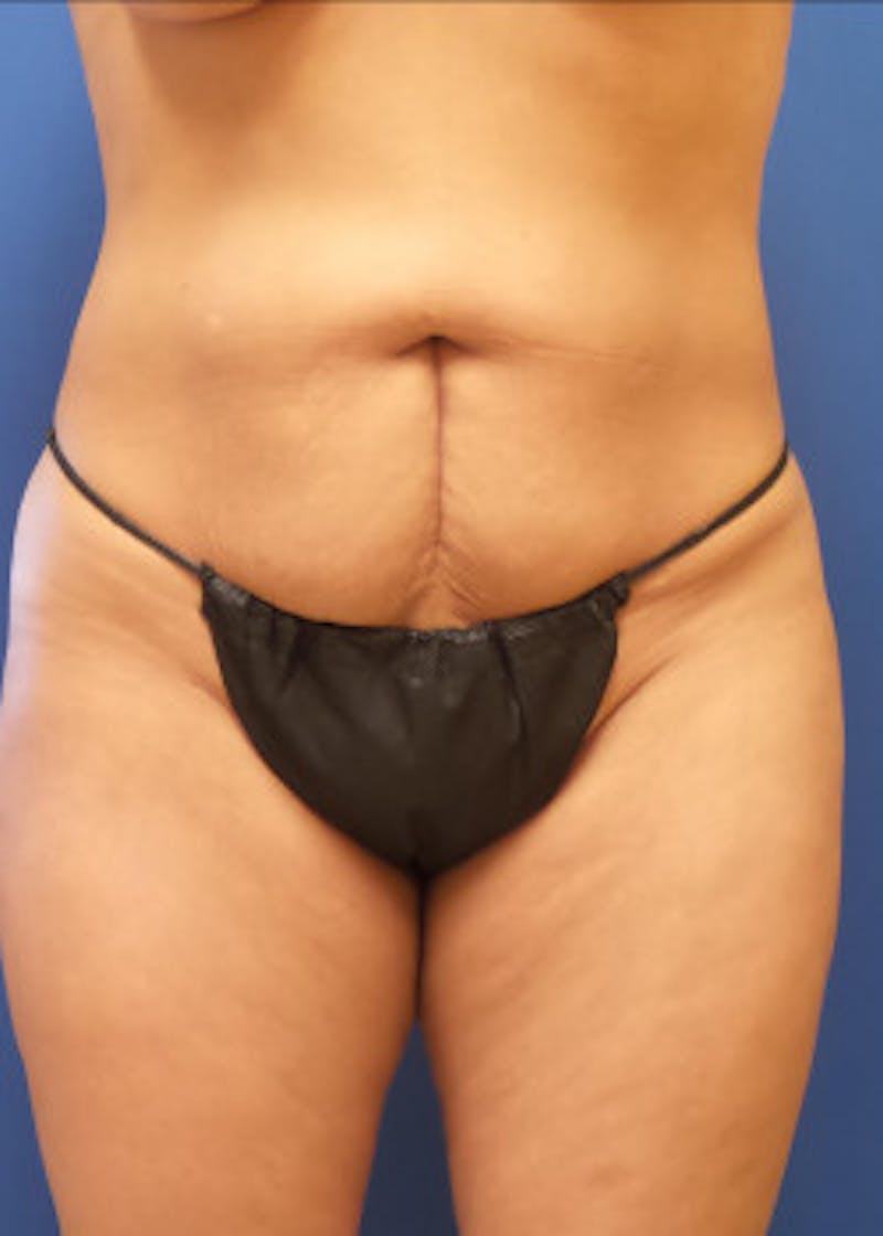 Tummy Tuck Before & After Gallery - Patient 46612459 - Image 1