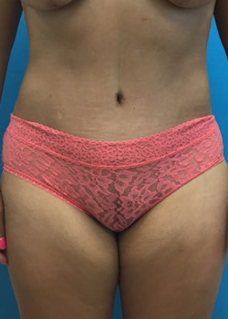 Tummy Tuck Before & After Gallery - Patient 46612459 - Image 2