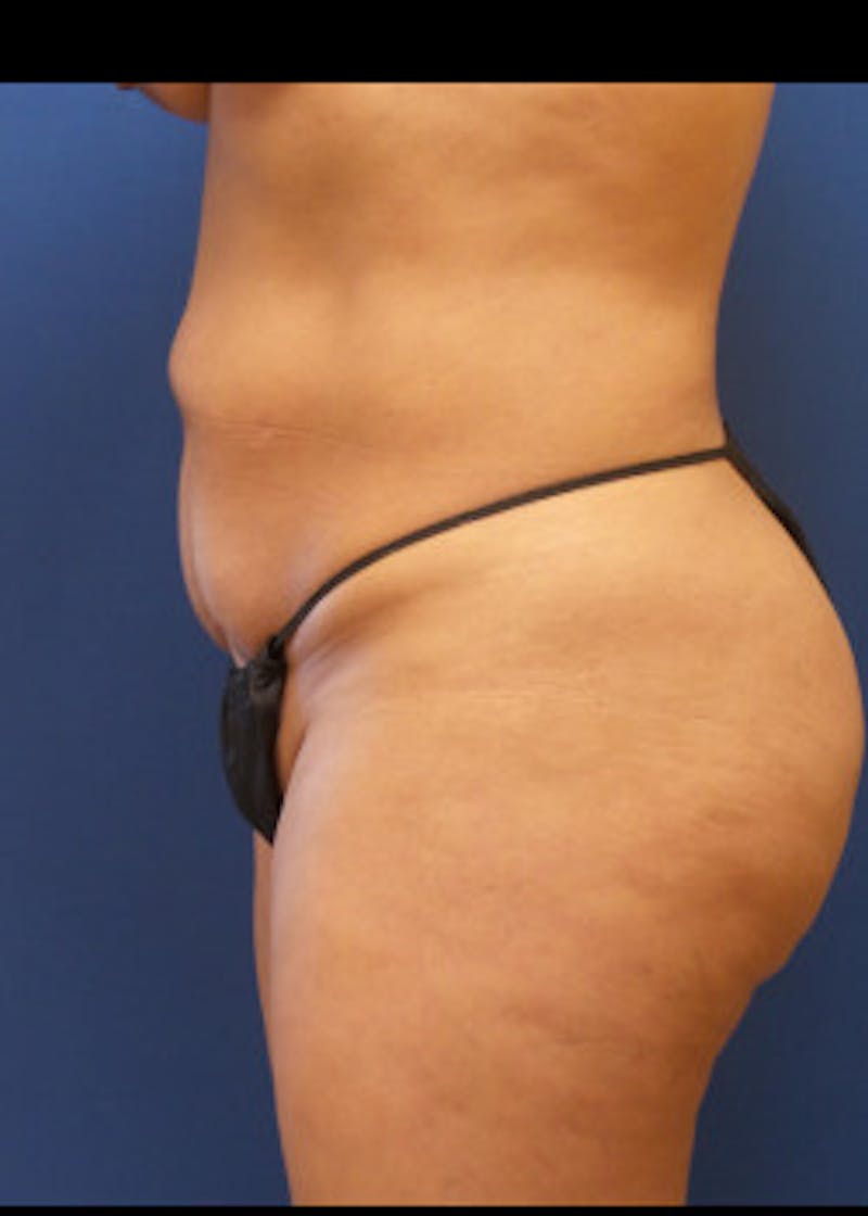 Tummy Tuck Before & After Gallery - Patient 46612459 - Image 3