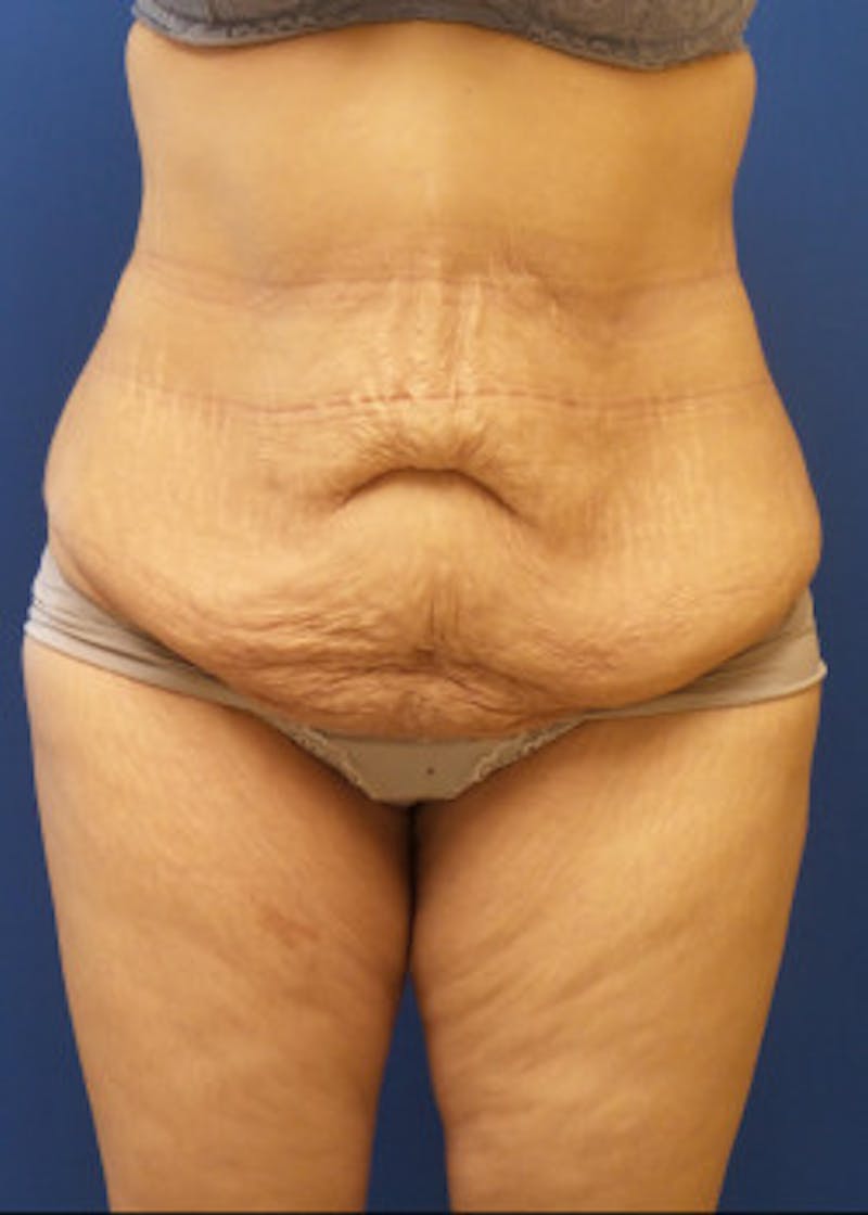 Tummy Tuck Before & After Gallery - Patient 46612494 - Image 1
