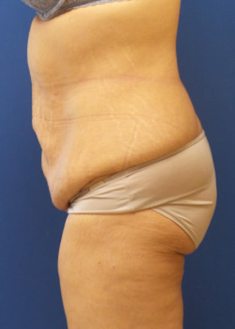 Tummy Tuck Before & After Gallery - Patient 46612494 - Image 3