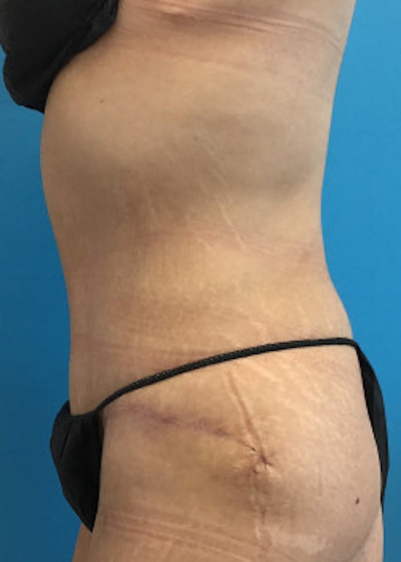 Tummy Tuck Before & After Gallery - Patient 46612494 - Image 4