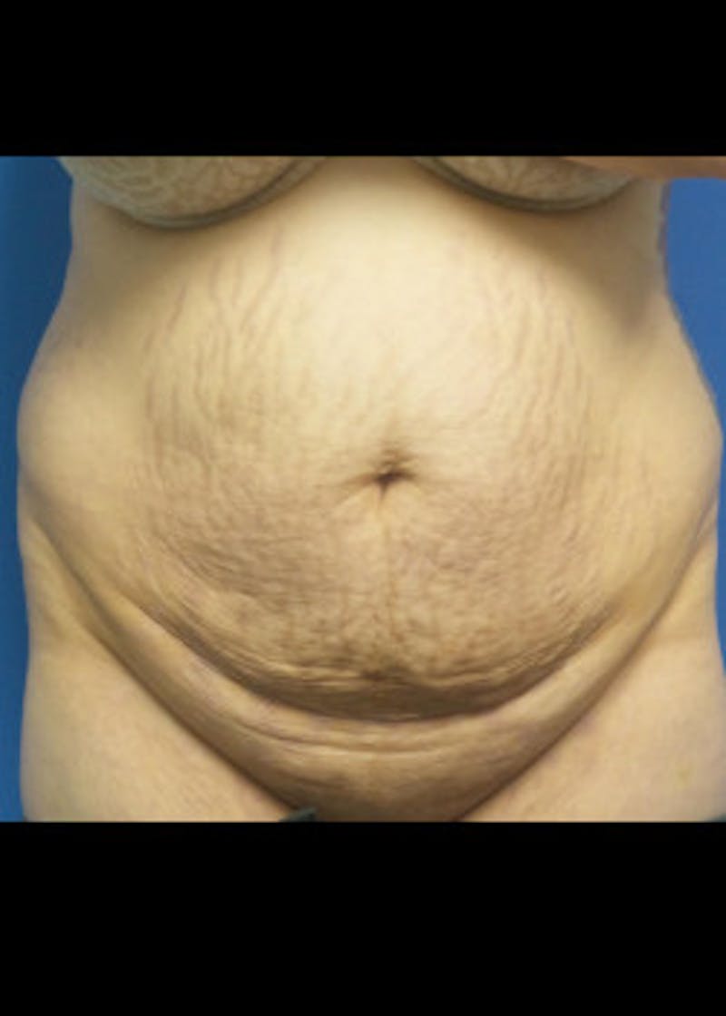 Tummy Tuck Before & After Gallery - Patient 46612595 - Image 1