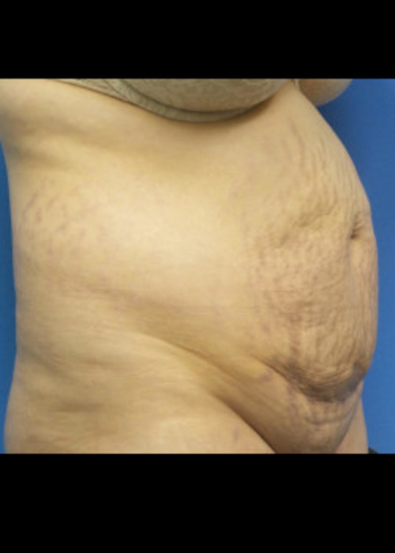 Tummy Tuck Before & After Gallery - Patient 46612595 - Image 3