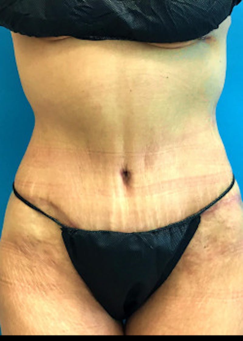 Tummy Tuck Before & After Gallery - Patient 46612599 - Image 2