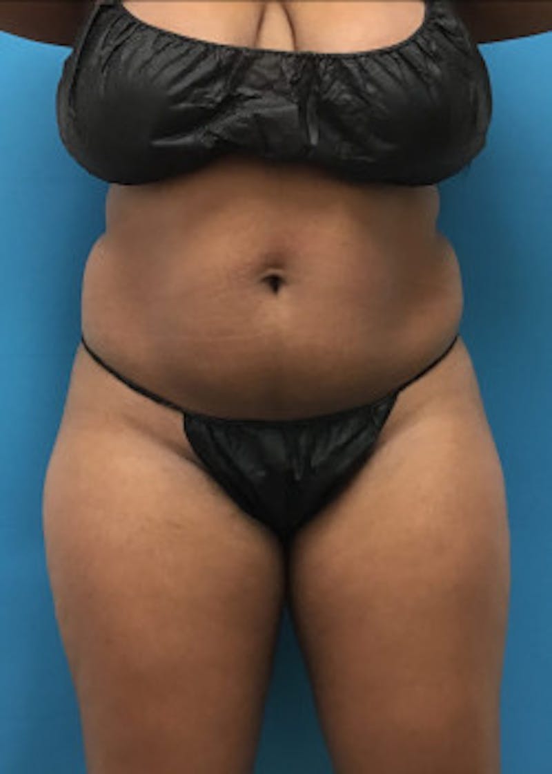Brazilian Butt Lift Before & After Gallery - Patient 46612607 - Image 1