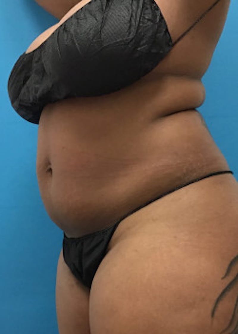 Brazilian Butt Lift Before & After Gallery - Patient 46612607 - Image 3