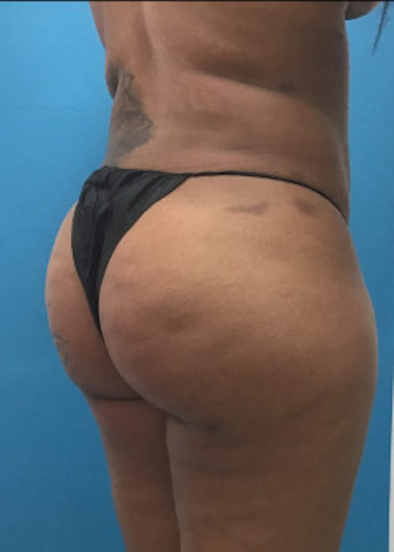 Brazilian Butt Lift Before & After Gallery - Patient 46612607 - Image 6