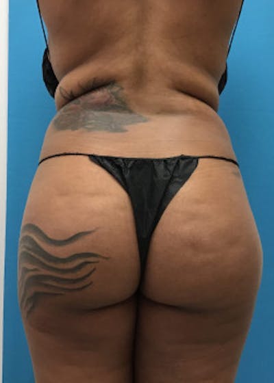 Brazilian Butt Lift Before & After Gallery - Patient 46612607 - Image 1