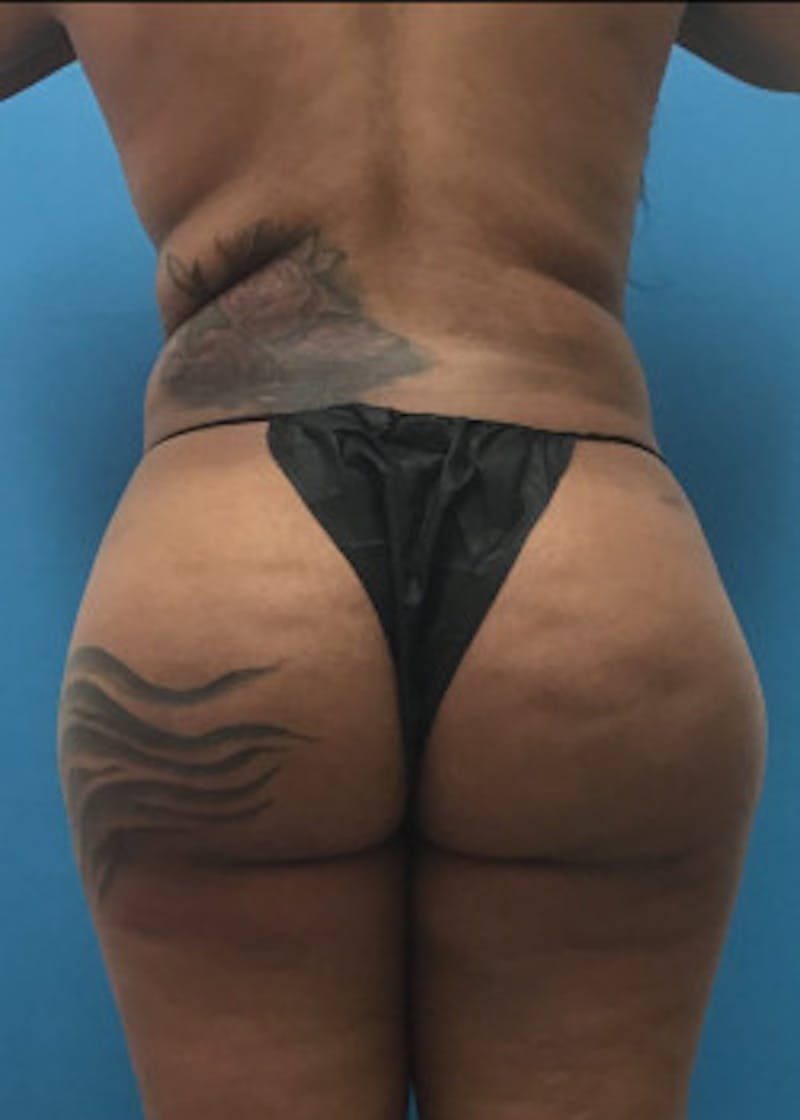 Brazilian Butt Lift Before & After Gallery - Patient 46612607 - Image 8