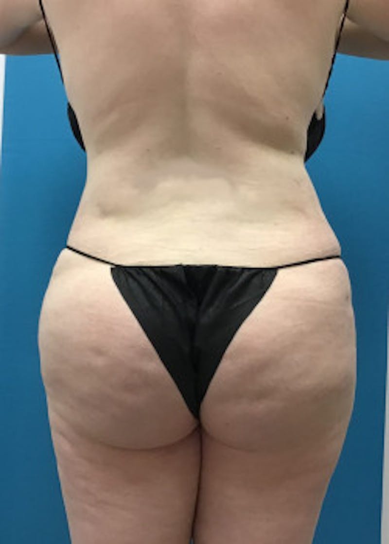 Brazilian Butt Lift Before & After Gallery - Patient 46612608 - Image 2