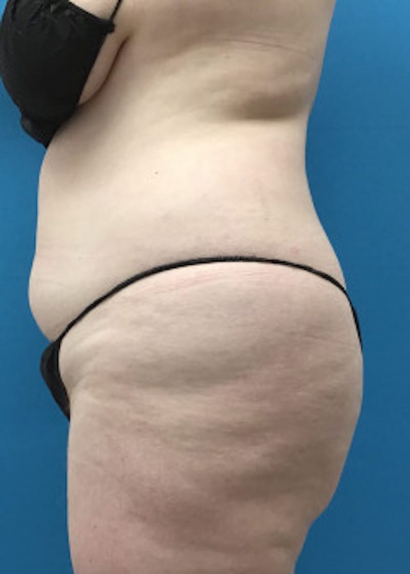 Brazilian Butt Lift Before & After Gallery - Patient 46612608 - Image 3