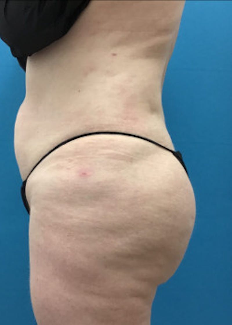 Brazilian Butt Lift Before & After Gallery - Patient 46612608 - Image 4