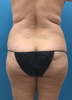 Brazilian Butt Lift Gallery - Patient 46612609 - Image 7