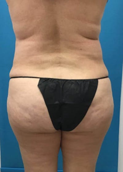 Brazilian Butt Lift Before & After Gallery - Patient 46612609 - Image 2