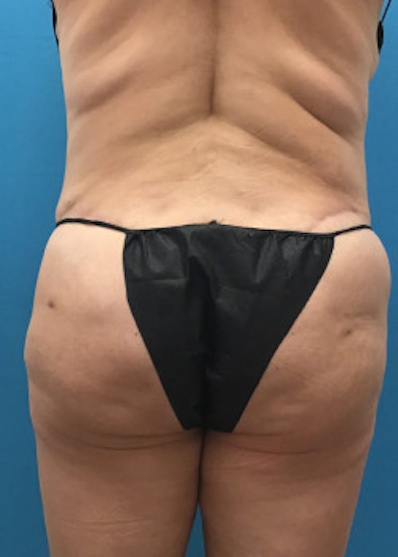 Brazilian Butt Lift Before & After Gallery - Patient 46612611 - Image 1