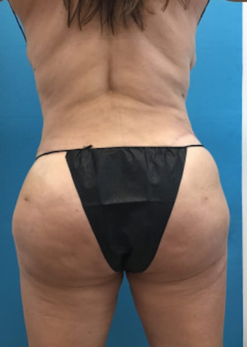 Brazilian Butt Lift Before & After Gallery - Patient 46612611 - Image 2