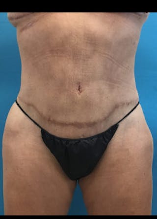 Brazilian Butt Lift Before & After Gallery - Patient 46612611 - Image 4