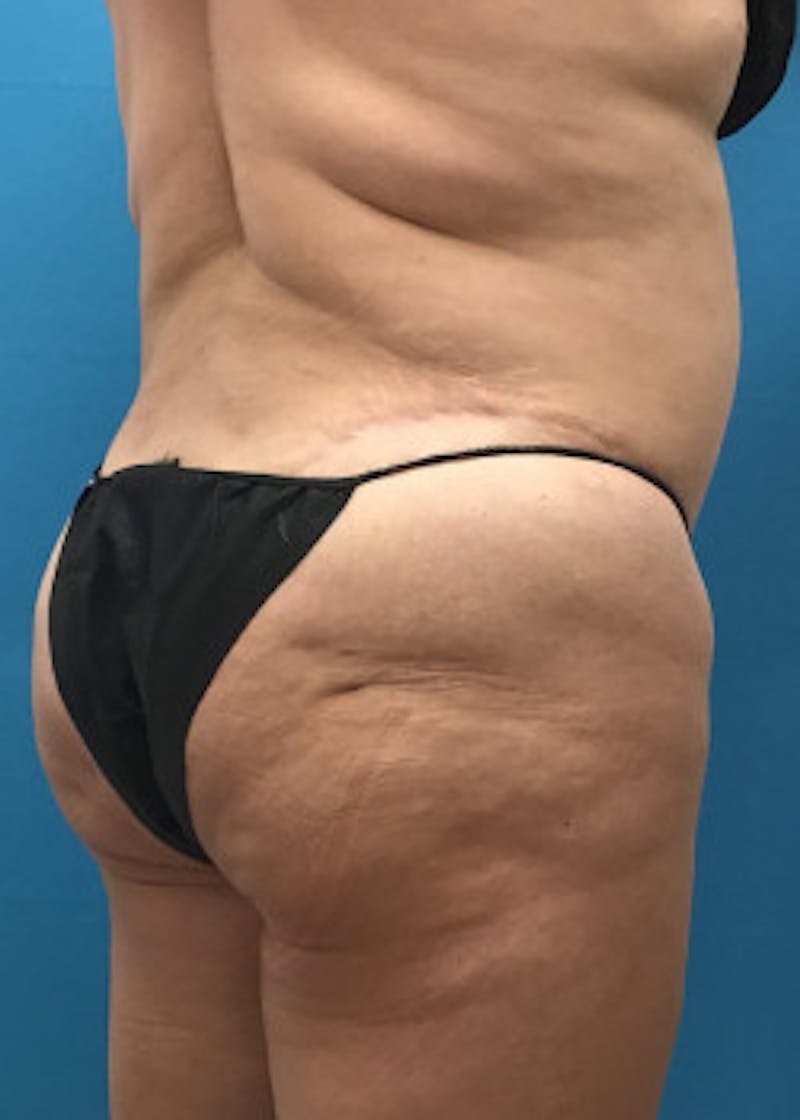 Brazilian Butt Lift Before & After Gallery - Patient 46612611 - Image 5