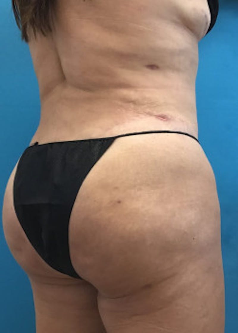 Brazilian Butt Lift Before & After Gallery - Patient 46612611 - Image 6