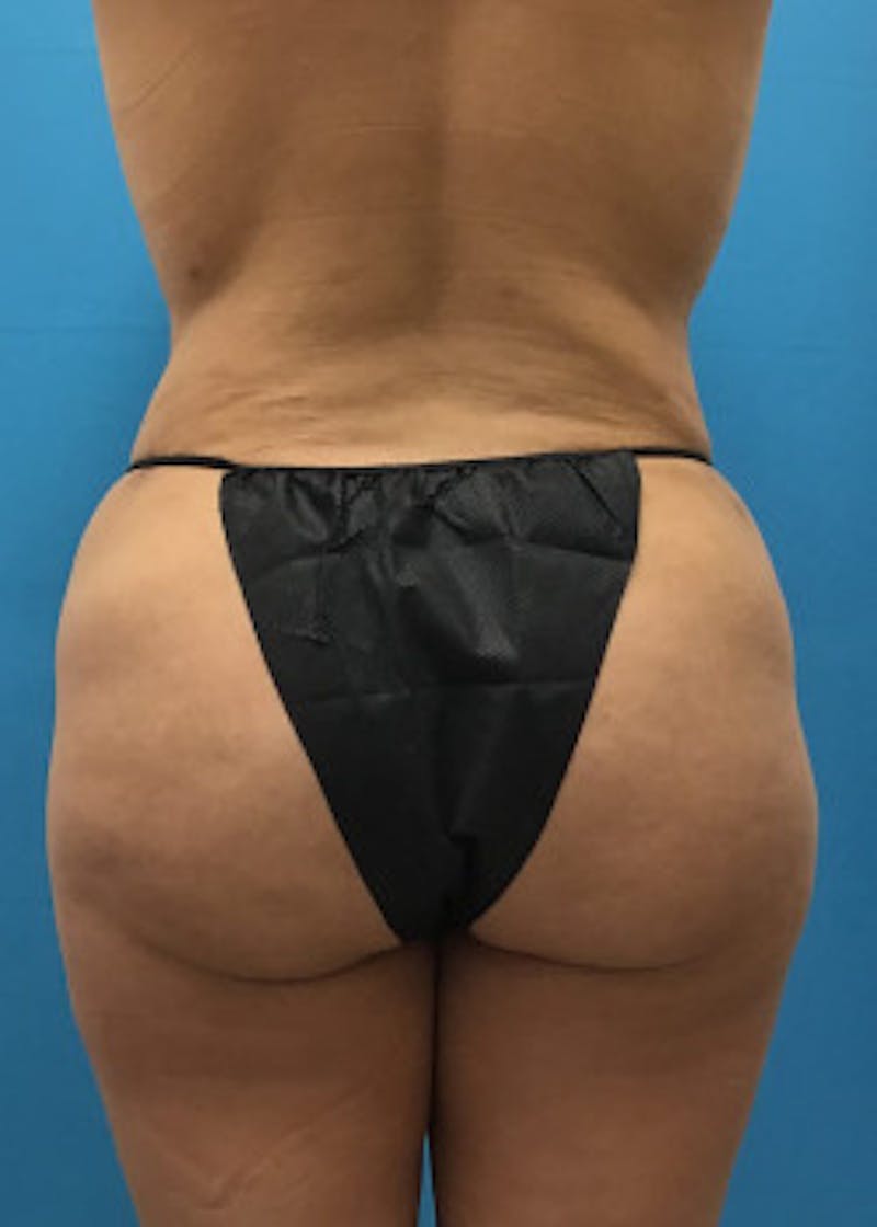 Brazilian Butt Lift Before & After Gallery - Patient 46612615 - Image 2