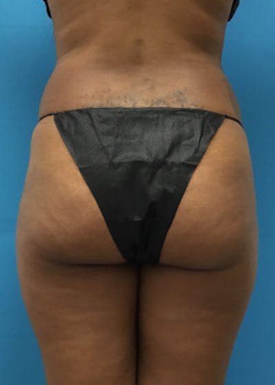 Brazilian Butt Lift Before & After Gallery - Patient 46612617 - Image 1