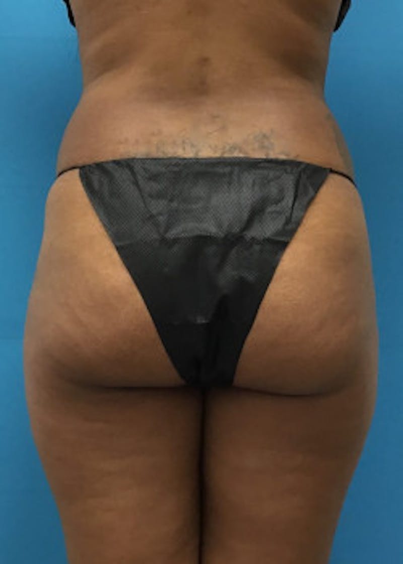 Brazilian Butt Lift Before & After Gallery - Patient 46612617 - Image 1