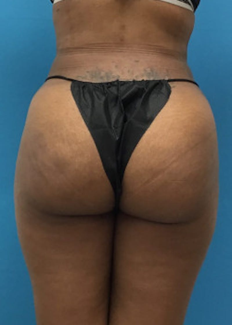 Brazilian Butt Lift Before & After Gallery - Patient 46612617 - Image 2