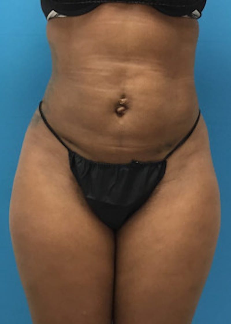 Brazilian Butt Lift Before & After Gallery - Patient 46612617 - Image 6