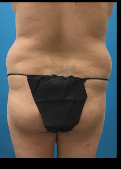 Brazilian Butt Lift Before & After Gallery - Patient 46612623 - Image 1