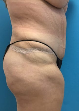 Lower Body Lift Before & After Gallery - Patient 46612647 - Image 6