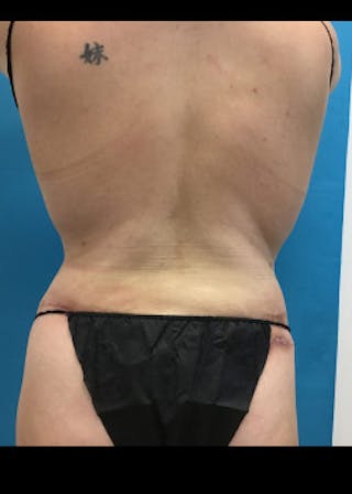 Lower Body Lift Before & After Gallery - Patient 46612657 - Image 8