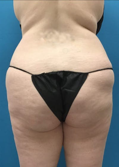 Lower Body Lift Before & After Gallery - Patient 46612676 - Image 1
