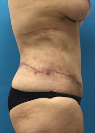 Lower Body Lift Before & After Gallery - Patient 46612707 - Image 4