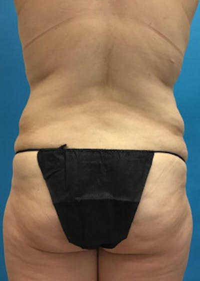 Lower Body Lift Before & After Gallery - Patient 46612707 - Image 1