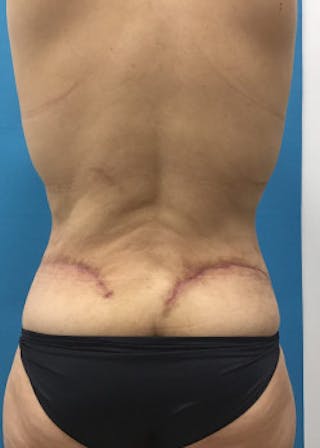 Lower Body Lift Before & After Gallery - Patient 46612707 - Image 2