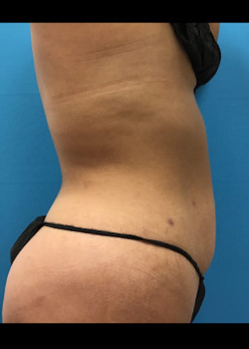BodyTite Before & After Gallery - Patient 46612786 - Image 3