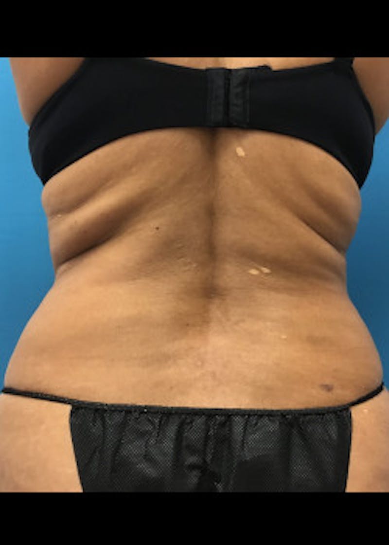 BodyTite Before & After Gallery - Patient 46612802 - Image 3