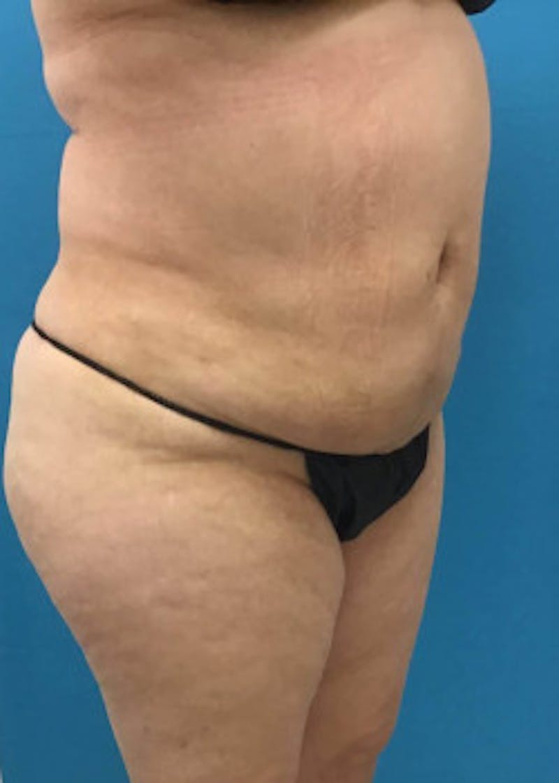 BodyTite Before & After Gallery - Patient 46612813 - Image 2