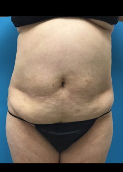 BodyTite Before & After Gallery - Patient 46612813 - Image 1