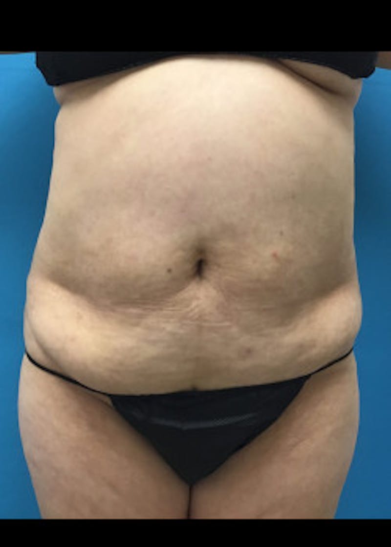 BodyTite Before & After Gallery - Patient 46612813 - Image 3