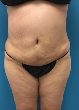 BodyTite Before & After Gallery - Patient 46612813 - Image 2