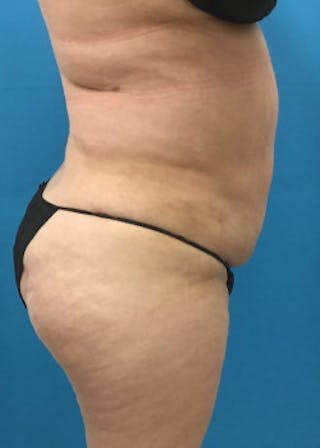 BodyTite Before & After Gallery - Patient 46612813 - Image 6