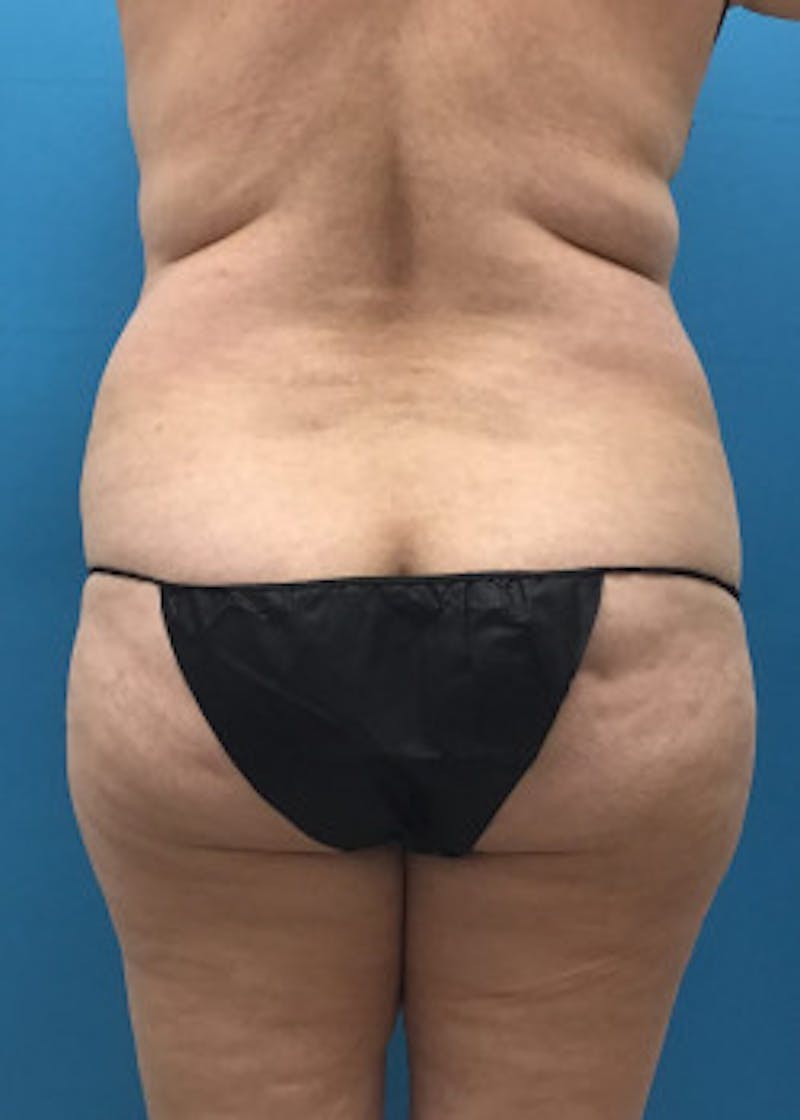 BodyTite Before & After Gallery - Patient 46612813 - Image 7