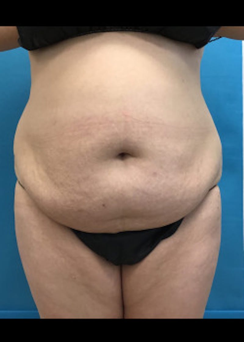 BodyTite Before & After Gallery - Patient 46612814 - Image 1