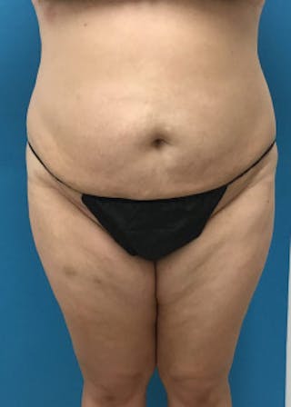 BodyTite Before & After Gallery - Patient 46612814 - Image 2