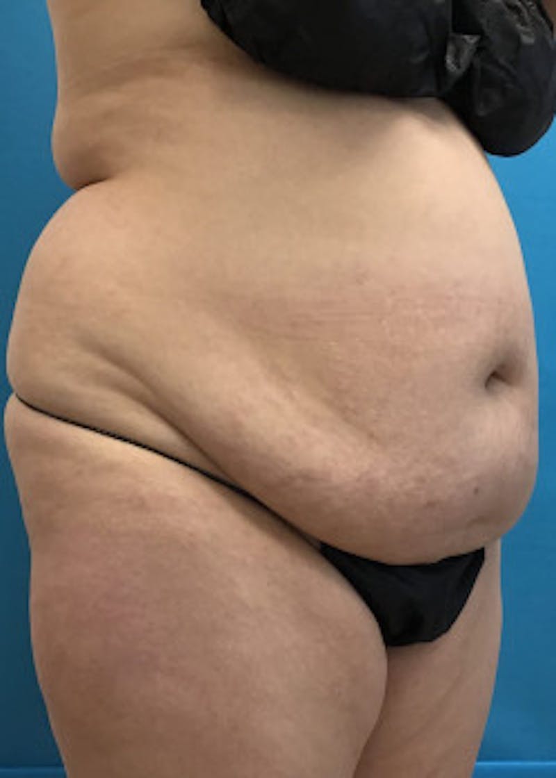 BodyTite Before & After Gallery - Patient 46612814 - Image 3